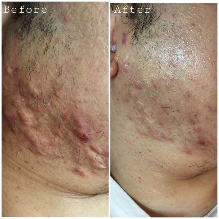 Acne Before & After